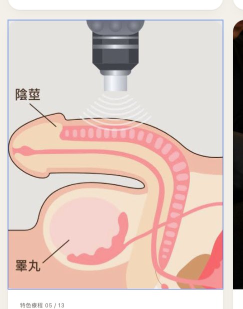 男士震波療程原理示意圖